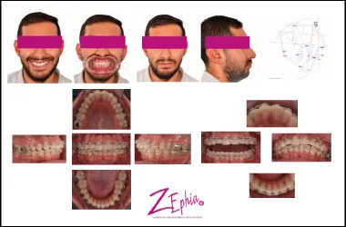 fotografía de dientes digital intraoral en Bogotá