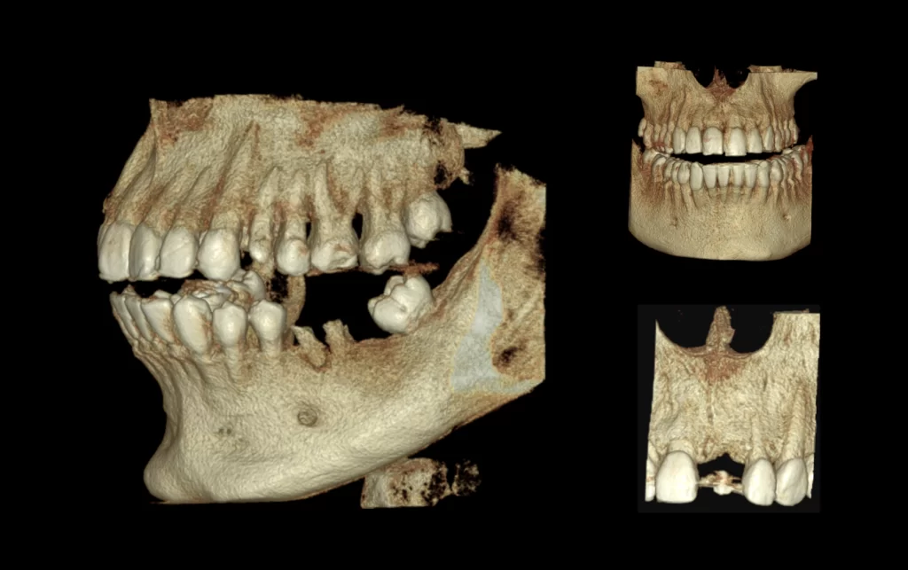 Resultado Tomografía Cone Beam