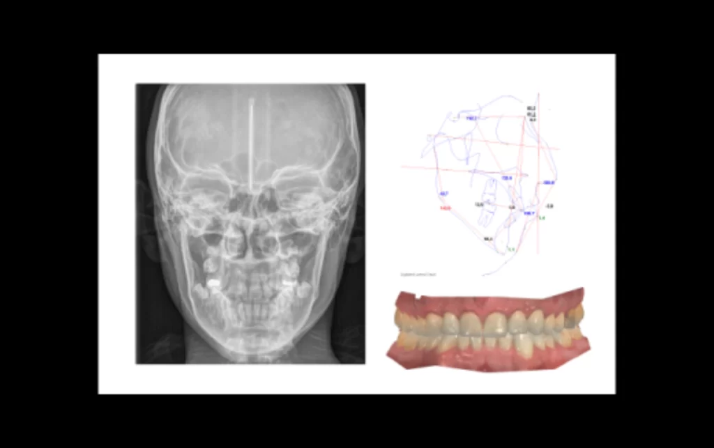 Modelo digital a partir de scanner intraoral