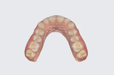 Escáner intraoral 3D