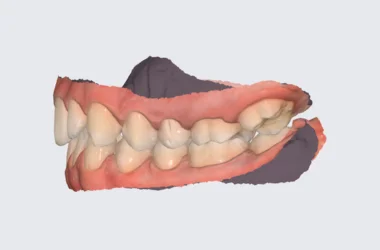 Impresión digital de scanner dental 3D