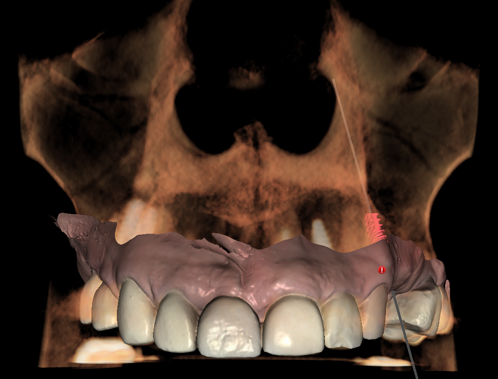 integración cbct y scan intraoral