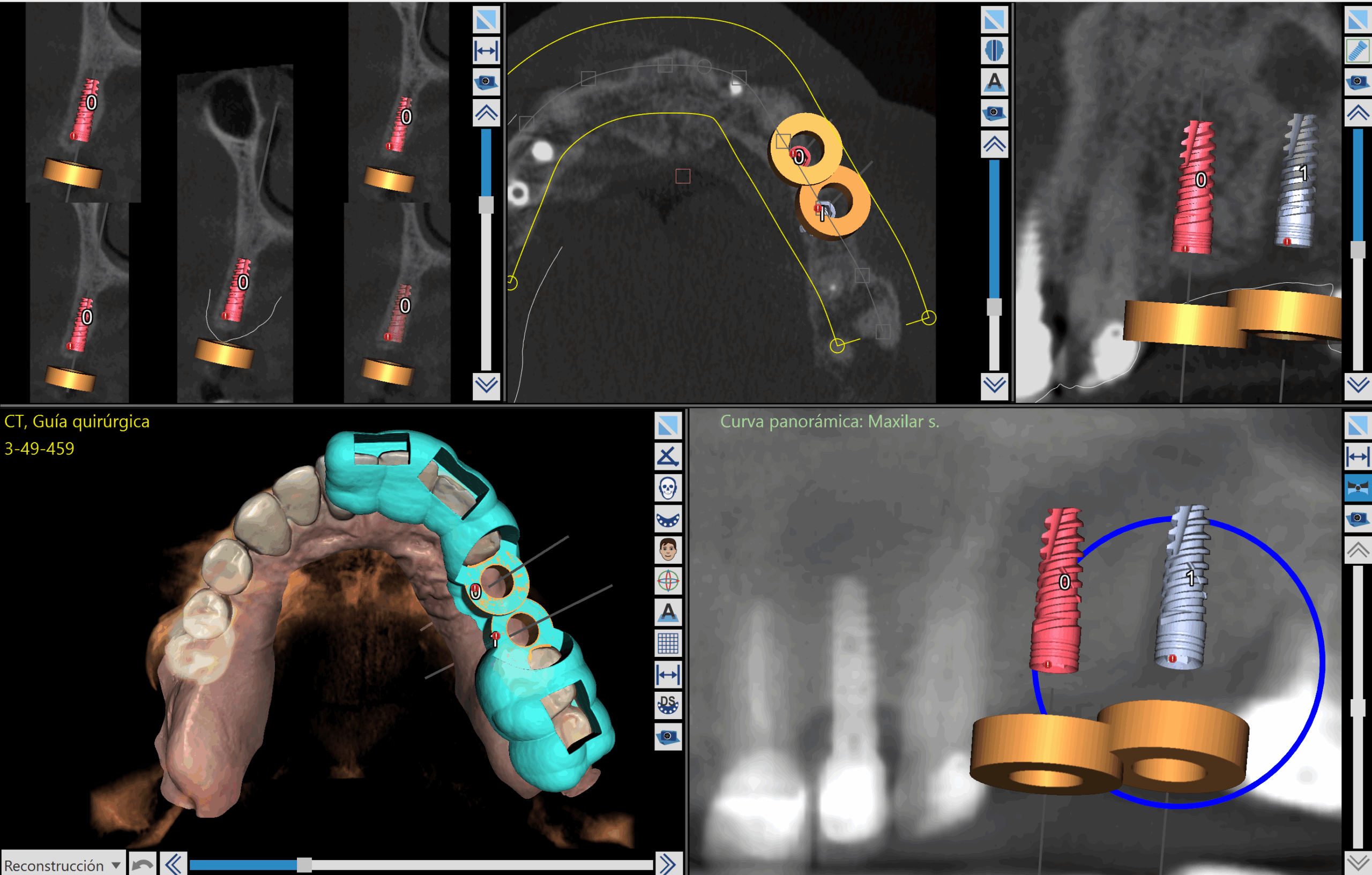diseño guía quirúrgica