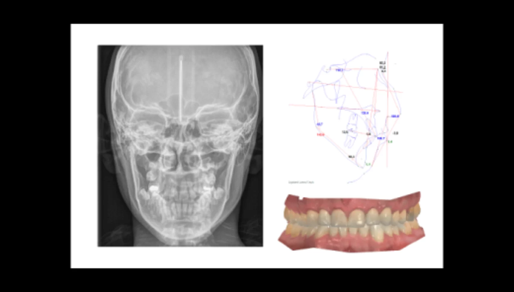 Modelo digital a partir de scanner intraoral